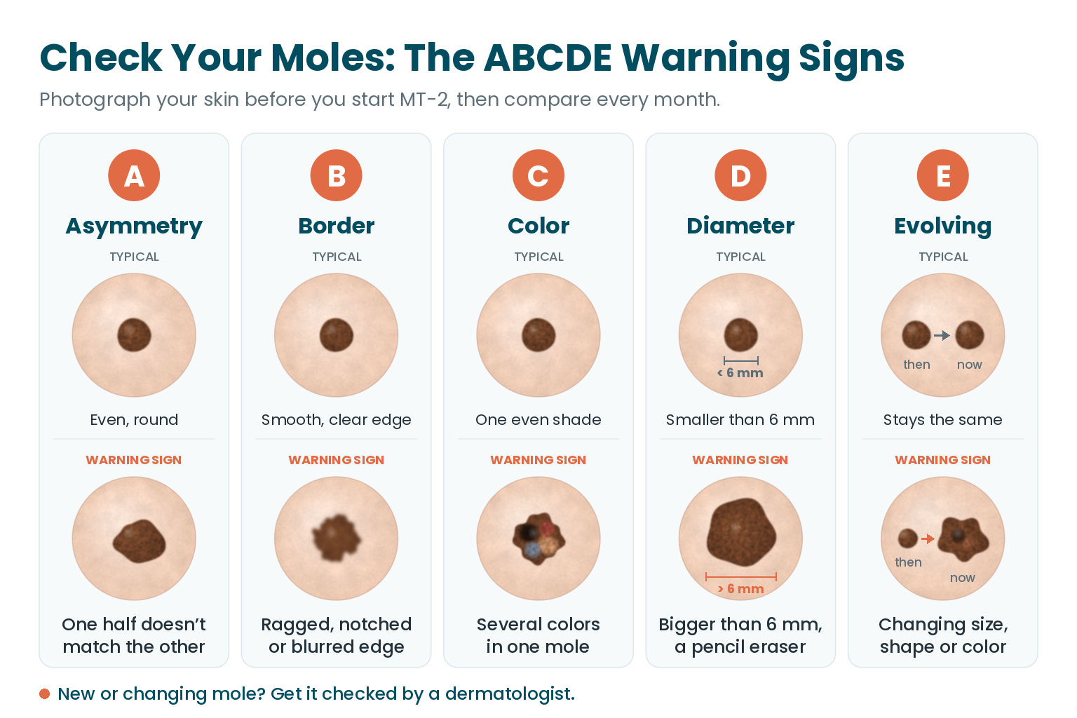 ABCDE mole check: typical moles compared with the warning signs of asymmetry, ragged borders, several colors, a diameter over 6 mm and changes over time